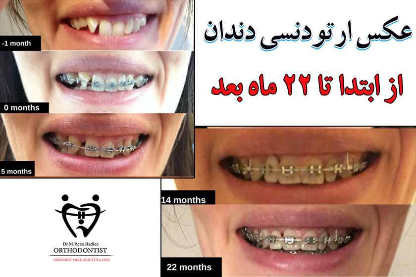 عکس ارتودنسی دندان قبل و بعد
